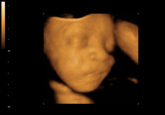 3D ultrasound image at 29 weeks